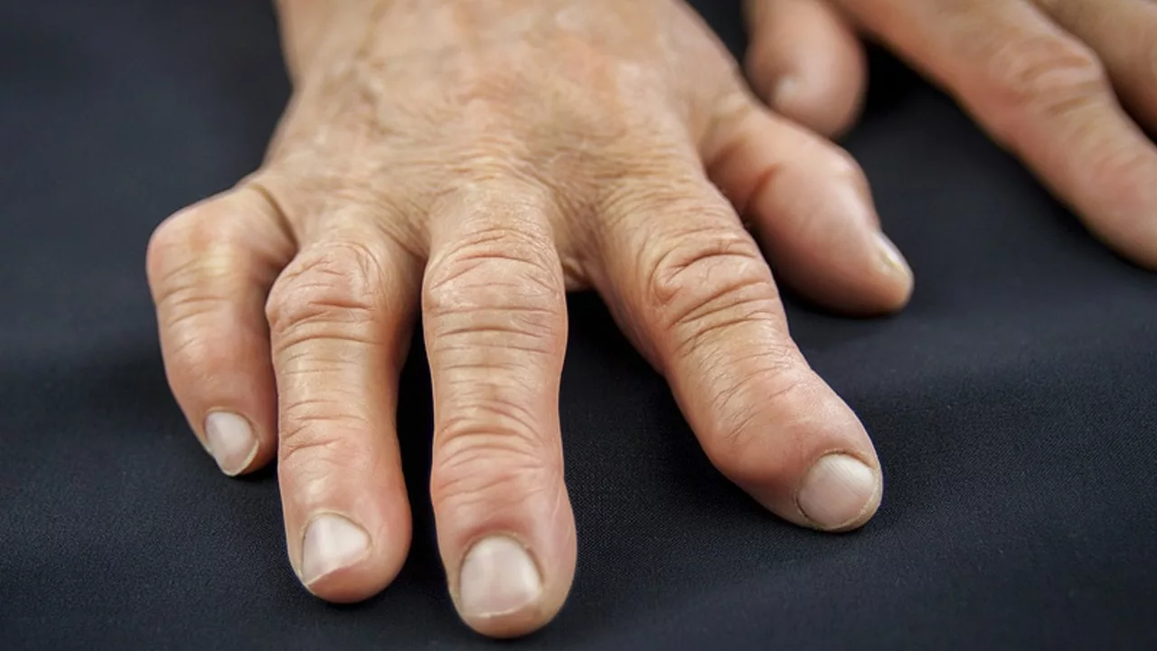 The Latest Advances in Rheumatoid Arthritis Research